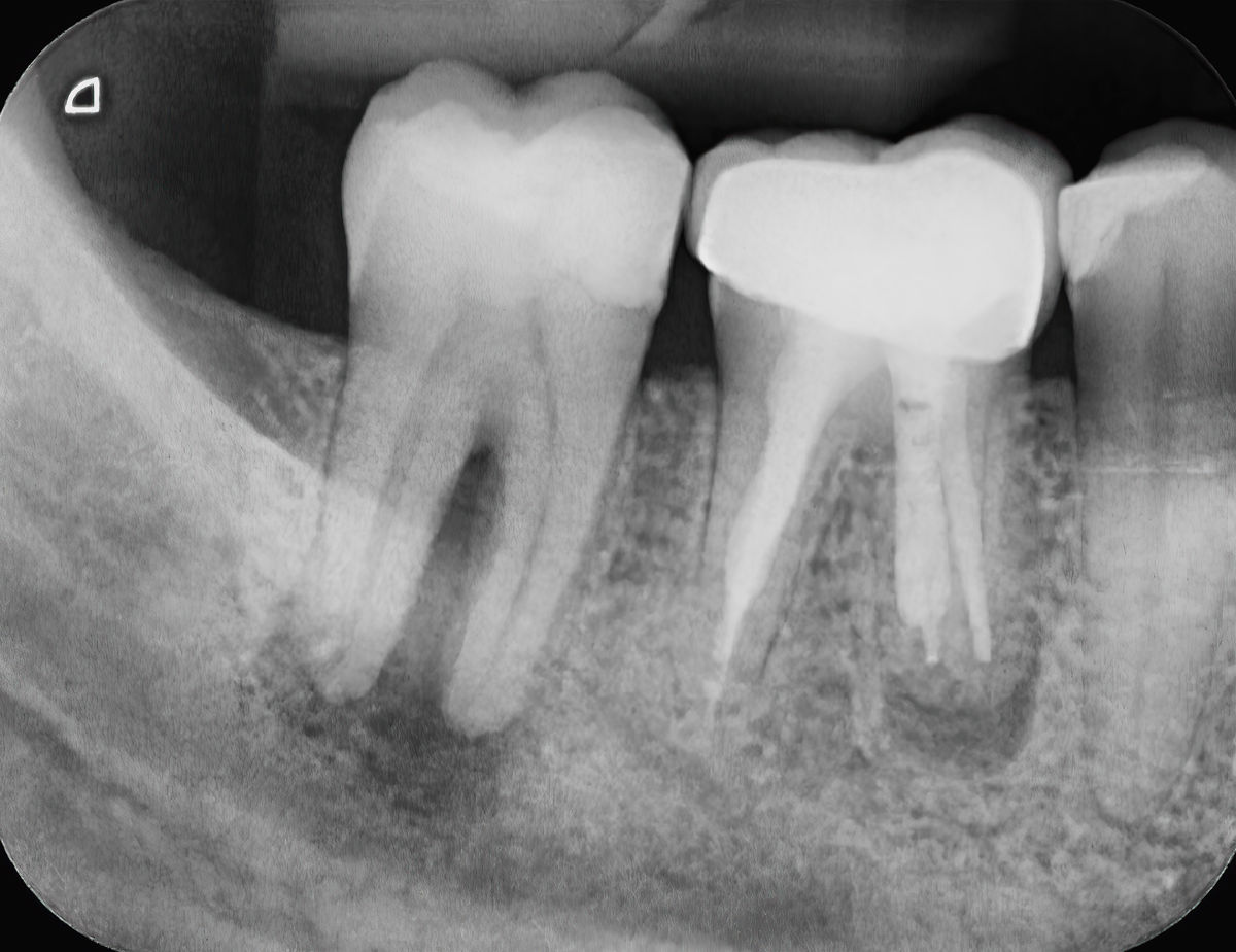 radiografia ascesso