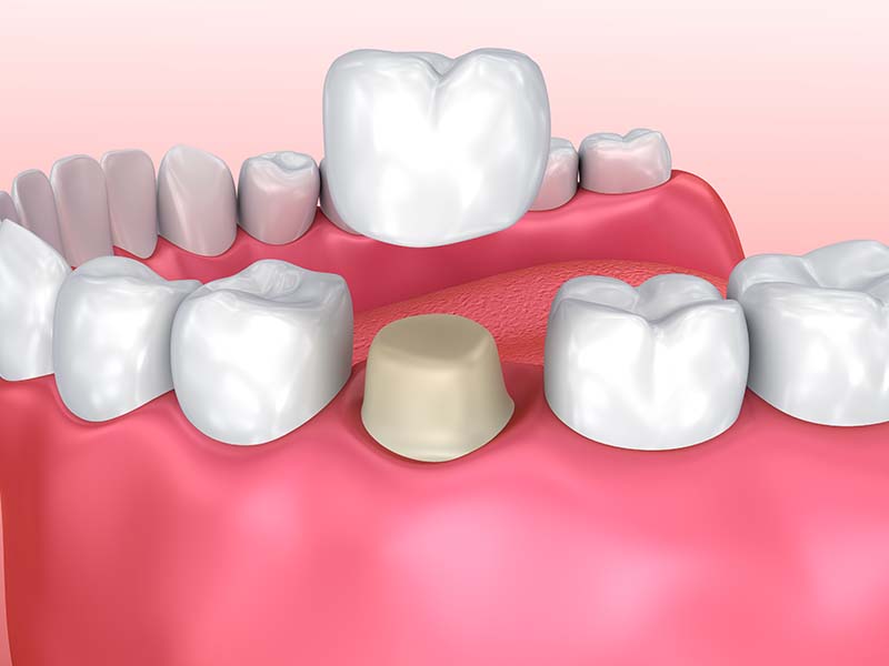 Corona dentale (o capsula): cos'è e quando è necessaria