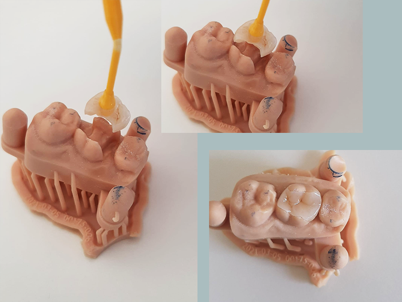 Cos'è l'intarsio dentale e a cosa serve