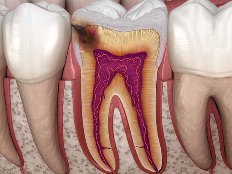 Pulpite: sintomi, cura e prevenzione