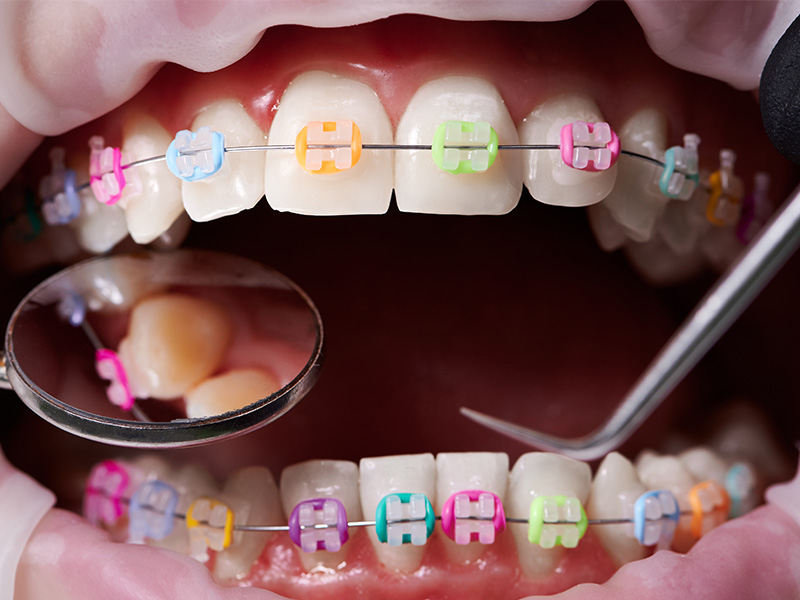 Qual è l'età giusta per l'apparecchio ortodontico?
