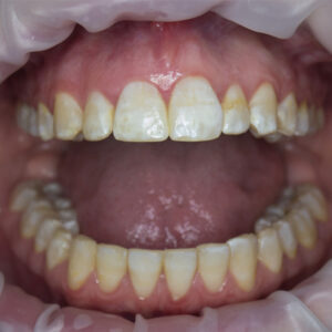 fluorosi dentale