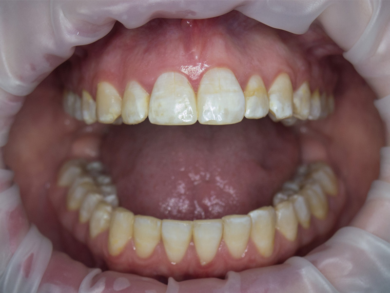 Fluorosi dentale: cos'è, come si manifesta e i rimedi
