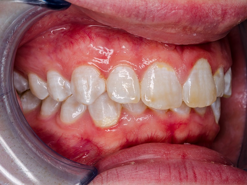 MIH: cos'è l'ipomineralizzazione dello smalto dentale?