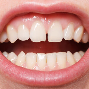 diastema dentale