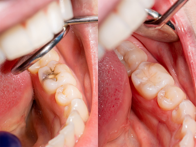 Otturazione del dente: scopriamo in cosa consiste