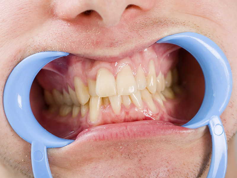 Affollamento dentale: cos'è e come si corregge