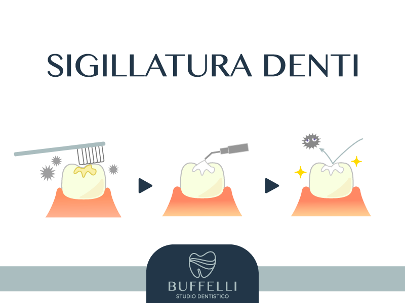 Sigillatura dei denti: cos'è e quando è necessaria