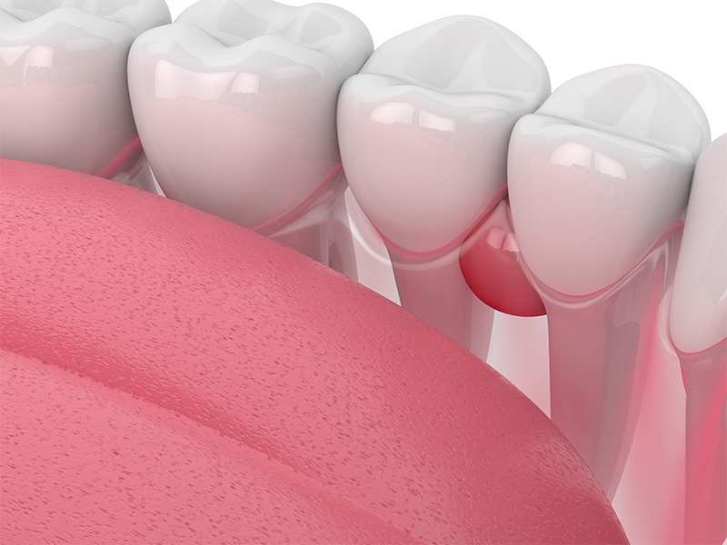 Cos'è il granuloma dentale e cosa fare