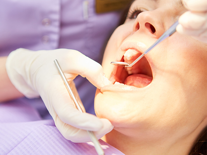 Perdita ossea dentale: tutto quello che devi sapere
