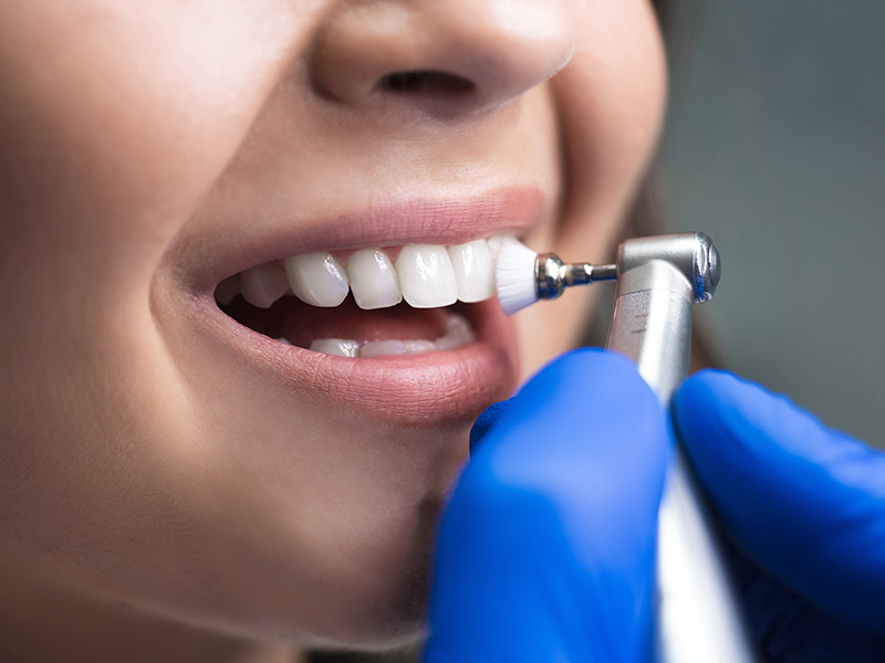 Pulizia dentale professionale: come si svolge e perché farla