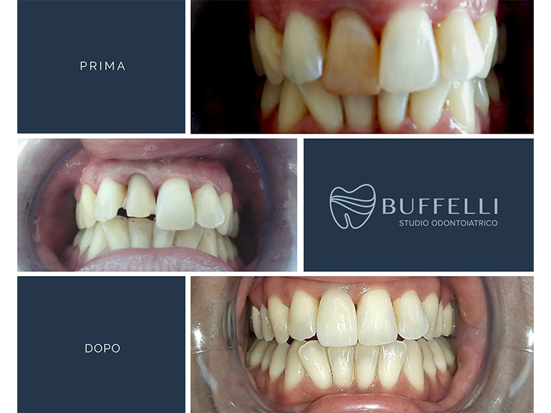 Dente nero: quali sono le cause e cosa fare