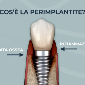 perimplantite