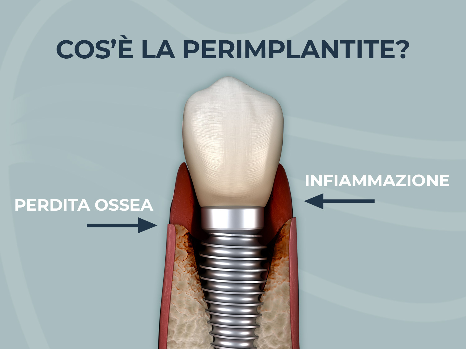 Infezione a un impianto dentale? Parliamo di perimplantite