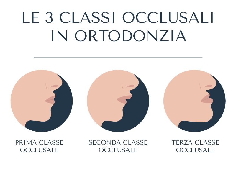 Prima, seconda o terza classe occlusale in ortodonzia
