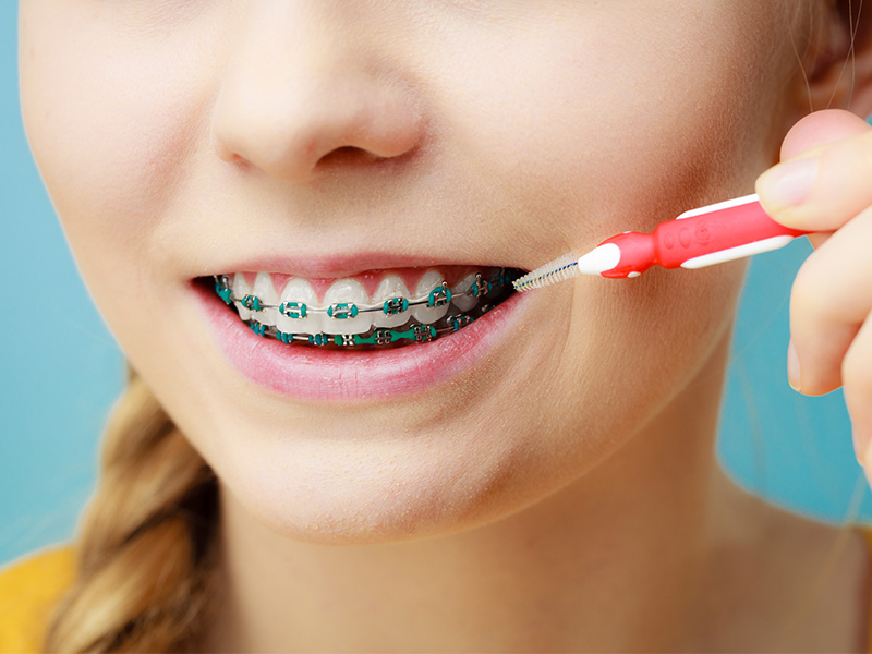 Scovolino per i denti: guida all'uso