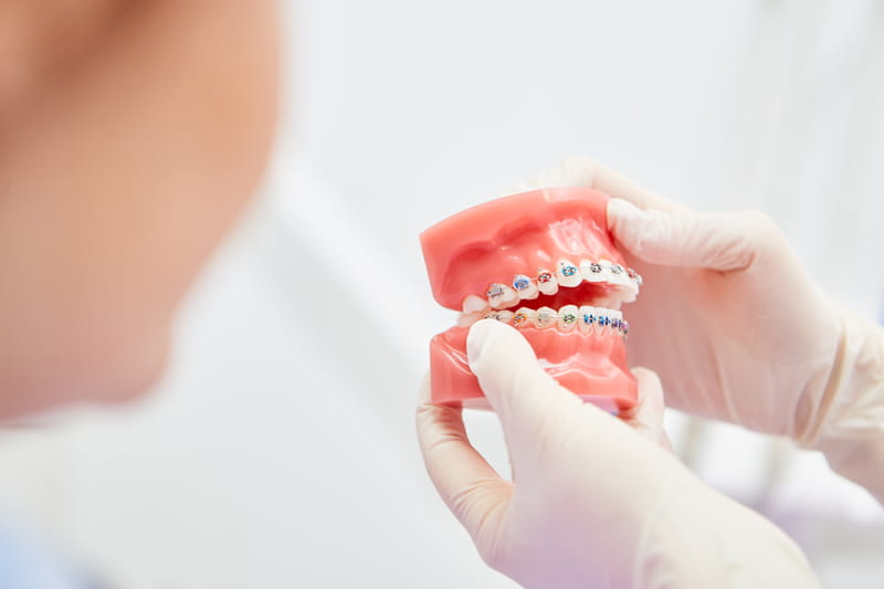 Denti storti dopo l'apparecchio: come evitare la recidiva ortodontica