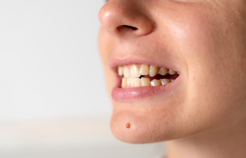 Denti che si muovono: perché e cosa fare?