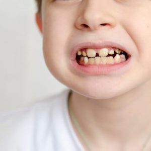 denti gialli in età pediatrica