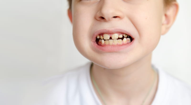 Denti gialli in età pediatrica: cause e rimedi