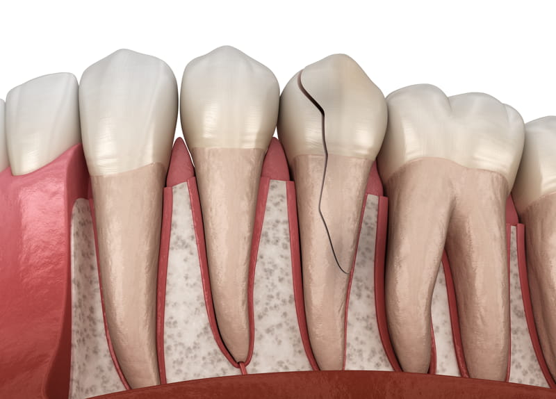 Frattura radicolare del dente: cosa fare