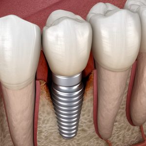 perimplantite o mucosite perimplantare