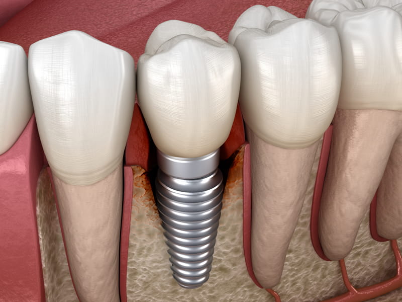 Qual è la differenza tra perimplantite e mucosite perimplantare?