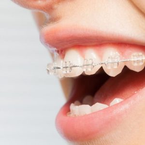 apparecchio ortodontico