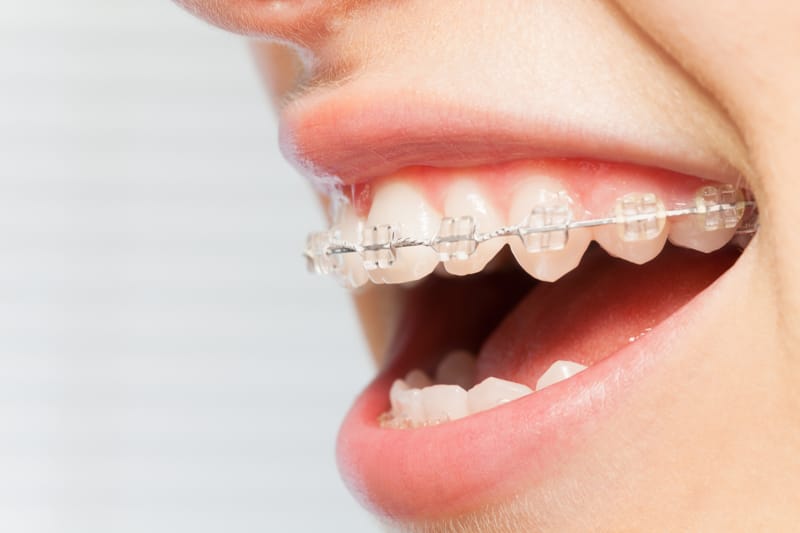 Apparecchio ortodontico e falsi miti: facciamo chiarezza!
