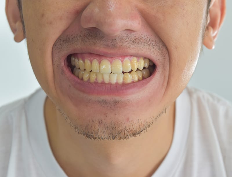 Denti gialli: cause, rimedi e prevenzione