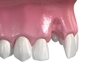 Agenesia dentale: assenza congenita di uno o più denti