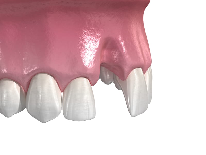 Agenesia dentale: assenza congenita di uno o più denti