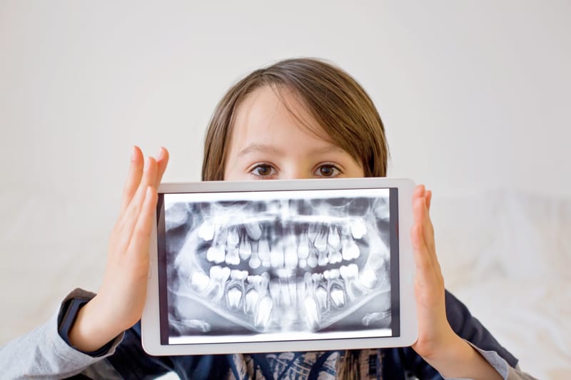 Radiografie odontoiatriche nei bambini: ci sono rischi?