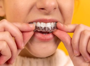 Quando è necessario utilizzare il bite dentale?