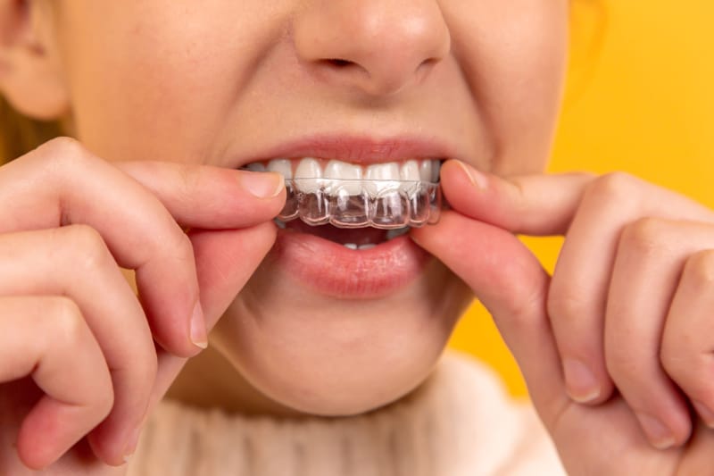 Quando è necessario utilizzare il bite dentale?