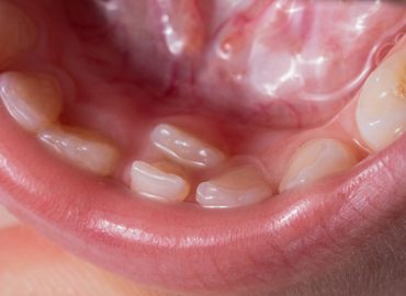 Denti sovrannumerari o iperdonzia: cosa fare?