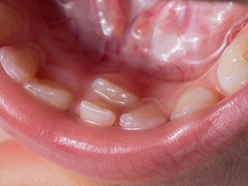Denti sovrannumerari o iperdonzia: cosa fare?