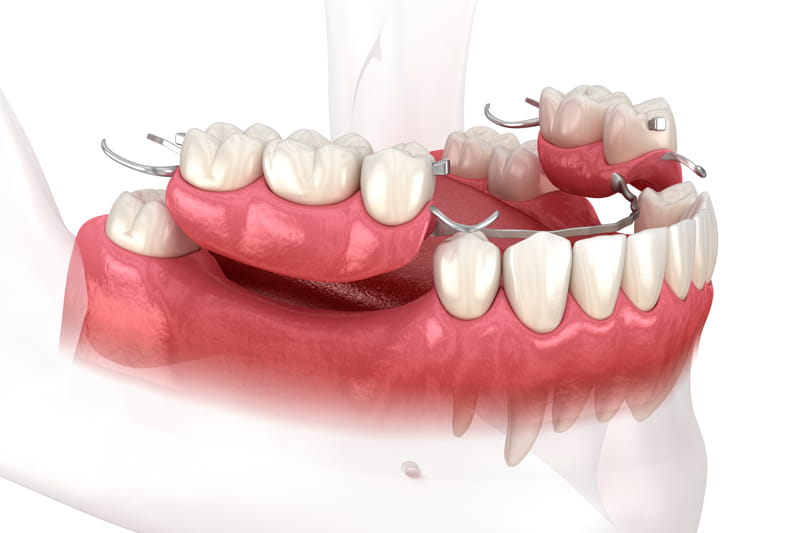 Ponte dentale fisso o scheletrato mobile: quale preferire?