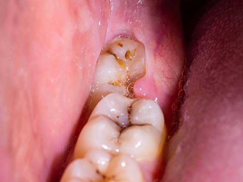 Cisti dentale: cos'è e come si cura