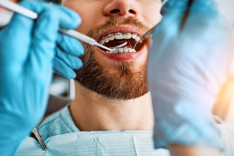 Apparecchio in età adulta: è possibile raddrizzare i denti da grandi?