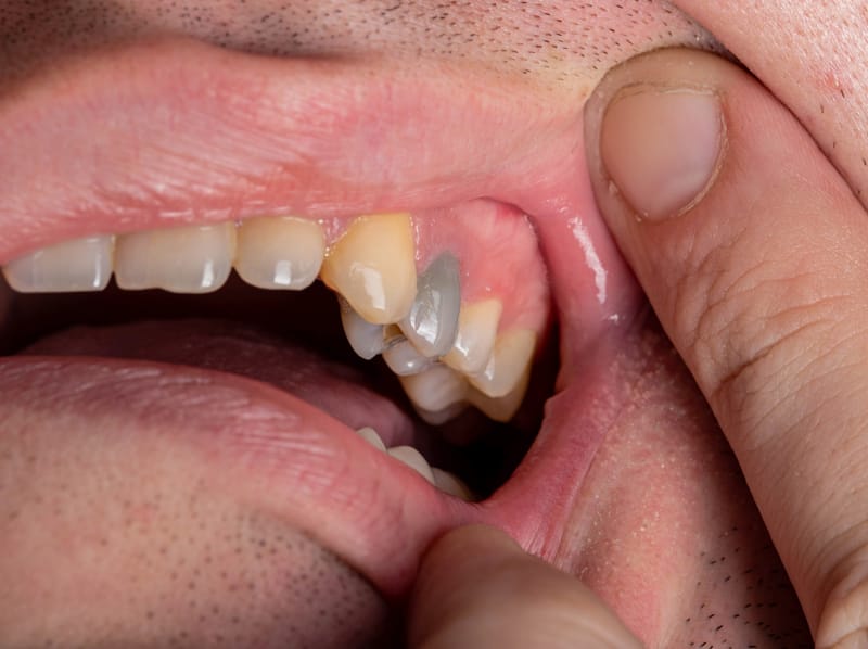 Dente grigio: quali sono le cause e i rimedi?
