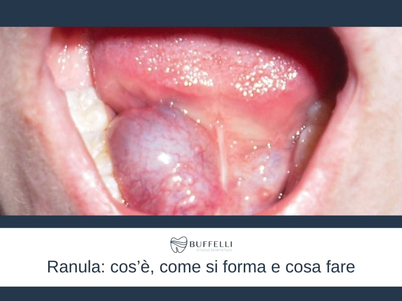 Ranula: cos’è, come si forma e cosa fare