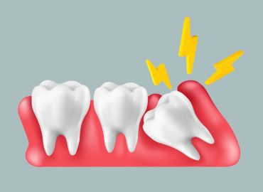 Quando i denti del giudizio spuntano solo in parte: cause, rischi e soluzioni