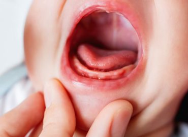 Frenulo linguale corto: perché riconoscerlo e trattarlo precocemente