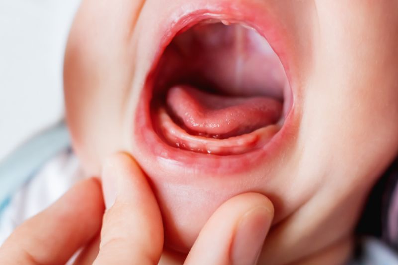 Frenulo linguale corto: perché riconoscerlo e trattarlo precocemente